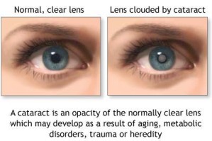 Cataracts